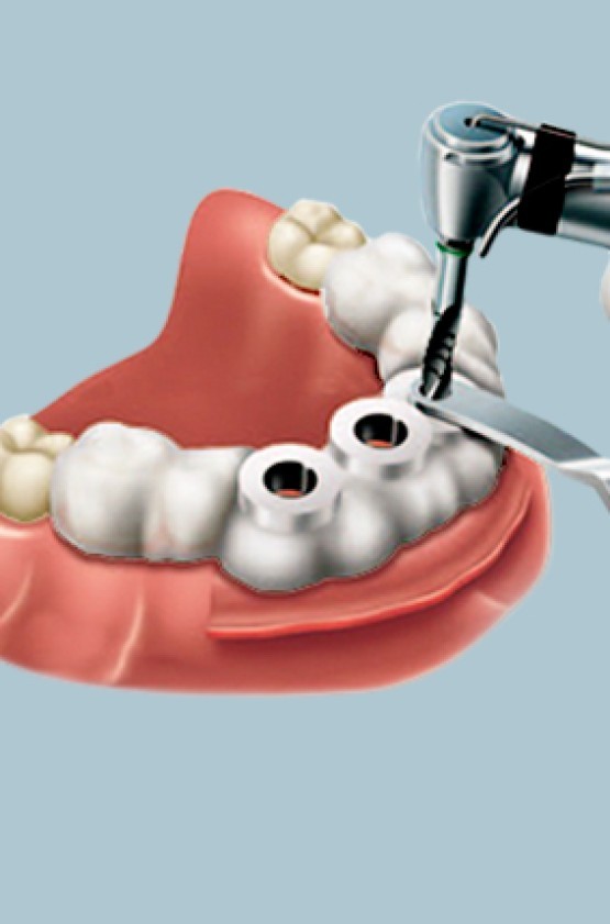 Guia para Implantes
