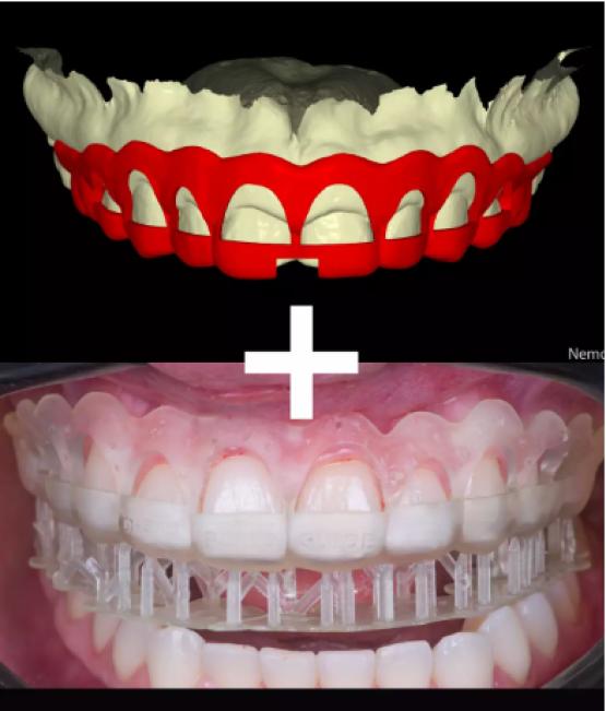Guia Periodontal (Perioguide/Gengivoplastia)
